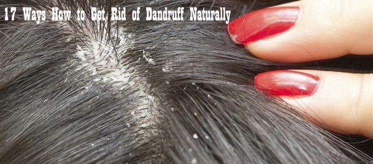 How to Get Rid of Dandruff Naturally